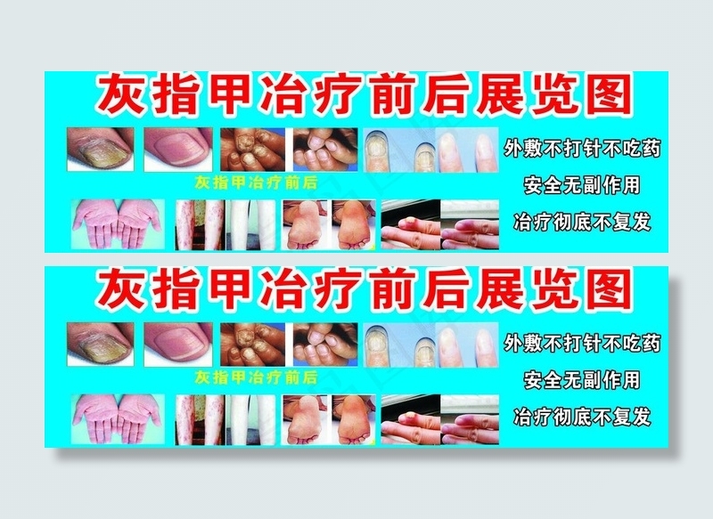 灰指甲冶疗前后展览图图片cdr矢量模版下载