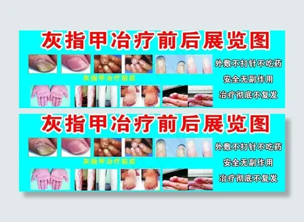 灰指甲冶疗前后展览图图片