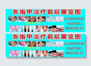 灰指甲冶疗前后展览图图片