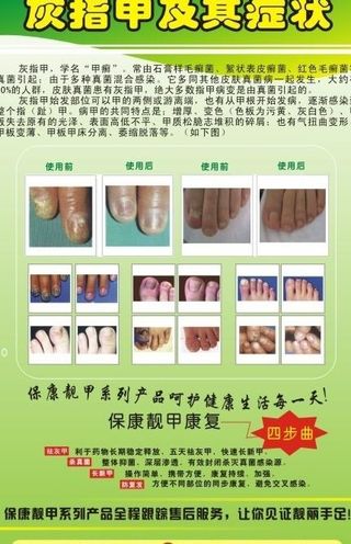 灰指甲及手足癣图片
