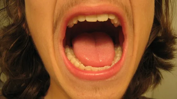 人物特写,口腔溃疡,牙齿矫正牙套,四环素牙,嘴唇,进入我的嘴