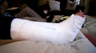 2012胫腓骨踝部骨折8484