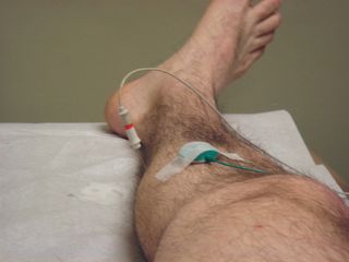 脚,腿,美足,踝关节,鸽子,“针状肌电图和神经传导研究”小腿