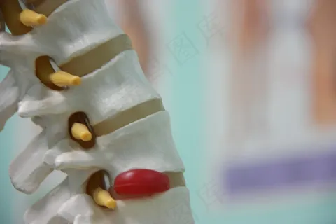 脊柱和椎间盘突出