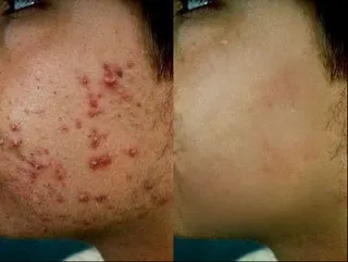 荨麻疹,扁平疣图片,风疹,体癣,红疙瘩,粉刺