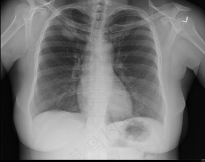 腺癌-X射线