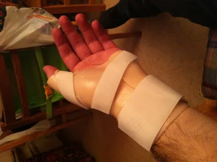 骨折破裂 骨折破裂