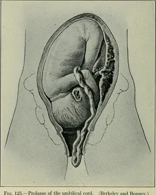 图片来自“护士的妇产科”（1922年）第313页