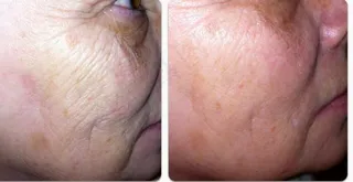 病理图,荨麻疹,脚,足癣,手,结果