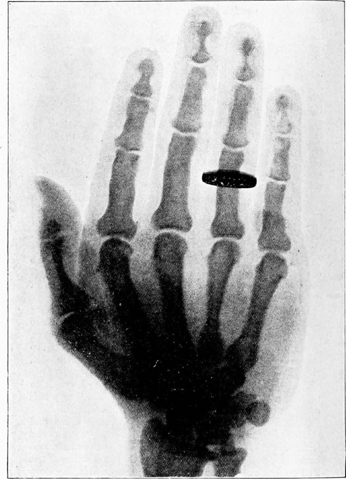 图片来自“ Acromegaly”（1899年）第63页