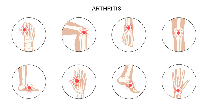 类风湿性关节炎、炎症、骨病概念。