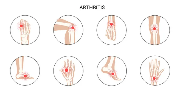 类风湿性关节炎、炎症、骨病概念。