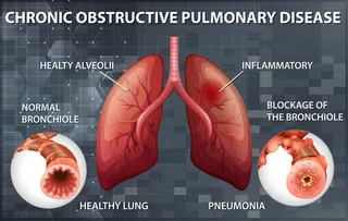 慢性阻塞性肺疾病
