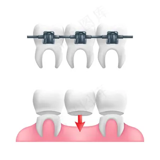 义齿概念-健康的牙齿，上面有固定的牙桥和牙套。