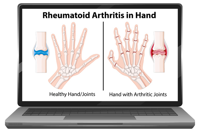 笔记本电脑屏幕上的类风湿性关节炎症状eps,ai矢量模版下载