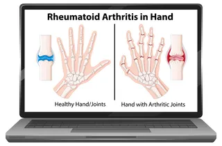 笔记本电脑屏幕上的类风湿性关节炎症状