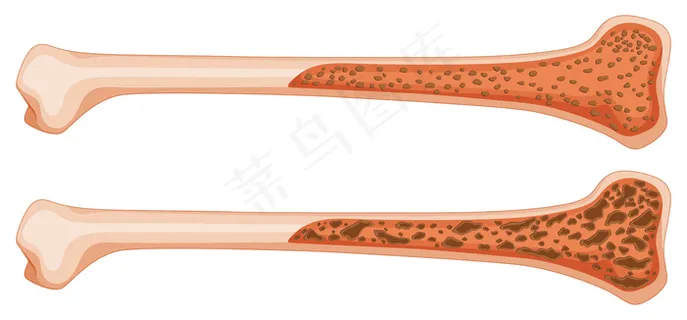 人骨骨质疏松症