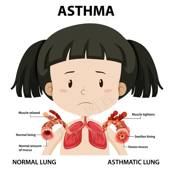 正常肺和哮喘肺的哮喘图