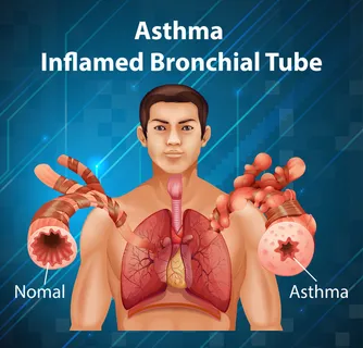人体解剖学哮喘发炎支气管图