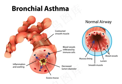 哮喘发炎支气管的信息说明