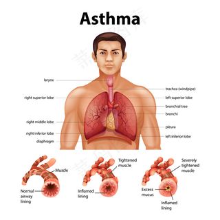 健康肺与哮喘肺的比较
