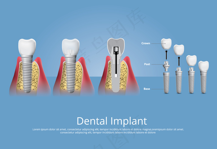 人类牙齿和牙种植体矢量图