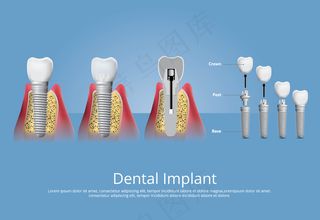 人类牙齿和牙种植体矢量图