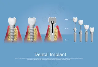 人类牙齿和牙种植体矢量图