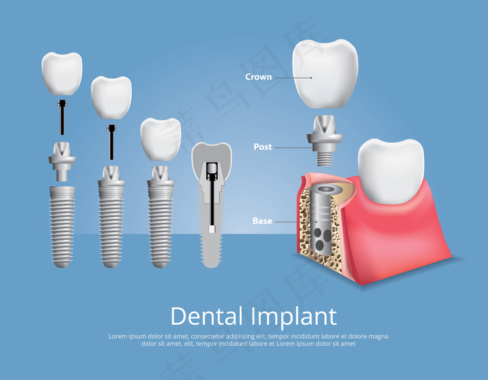 人类牙齿和牙种植插图