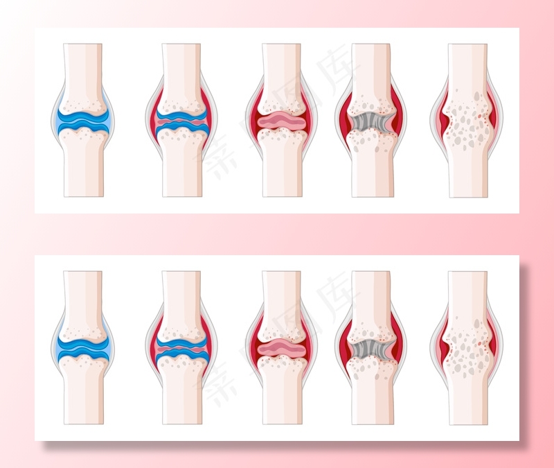 人体类风湿性关节炎插图