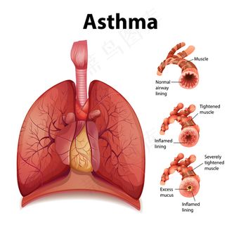 健康肺与哮喘肺的比较