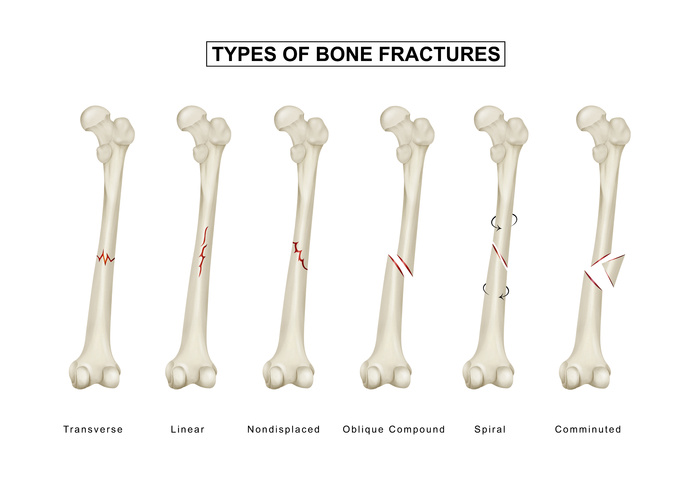 骨折类型 股骨干骨折eps,ai矢量模版下载