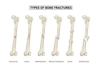 骨折类型 股骨干骨折