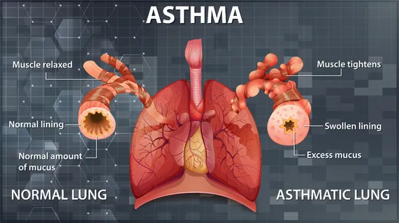 健康肺与哮喘肺的比较 健康肺与哮喘肺的比较