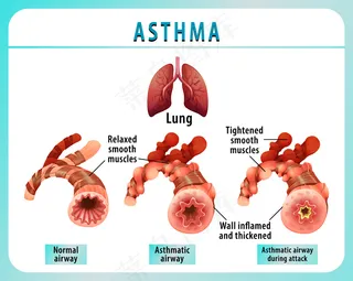 正常气道和哮喘气道的支气管哮喘图