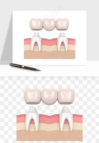 手绘牙齿矫正拔牙png免抠