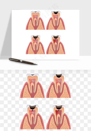 手绘牙齿矫正拔牙png免抠