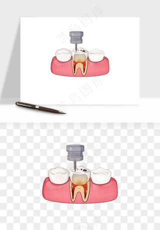 手绘牙齿矫正拔牙png免抠