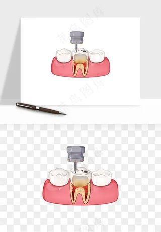 手绘牙齿矫正拔牙png免抠