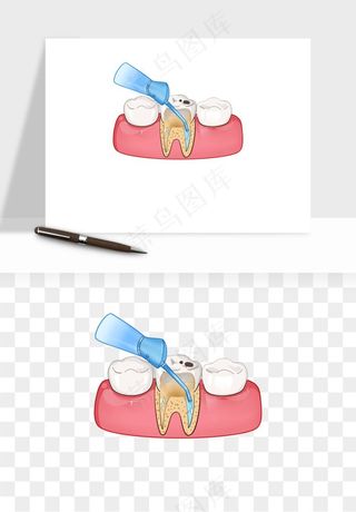 手绘牙齿矫正拔牙png免抠