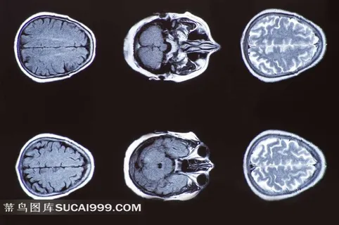 人体大脑X光片