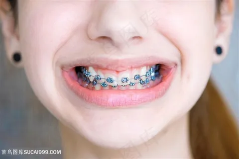 带牙套的小美女高清图片 带牙套的小美女高清图片
