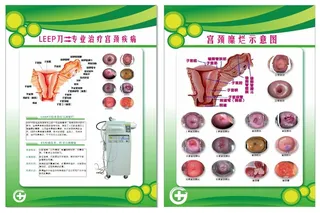 宫颈糜烂示意图