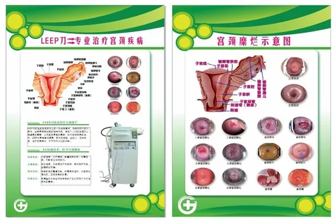 宫颈糜烂示意图 宫颈糜烂示意图
