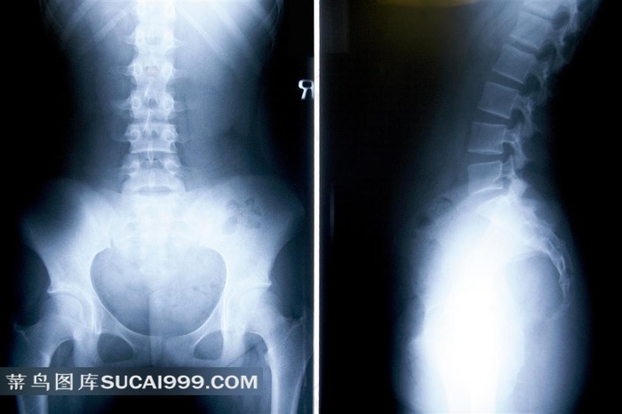 X光照射透明人体骨骼