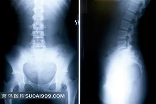 X光照射透明人体骨骼