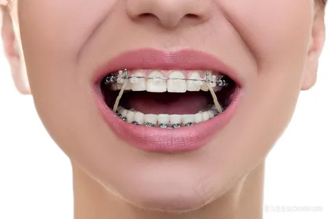 牙科牙齿戴牙套箍牙图片 牙科牙齿戴牙套箍牙图片