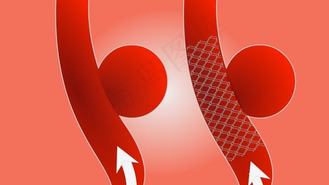 心, 导流, 流动, 动脉瘤, 心跳, 心电图, 医疗的