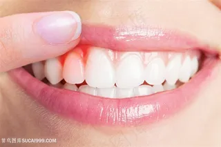 牙龈肿痛牙科牙齿