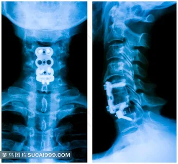 颈椎X光片图片